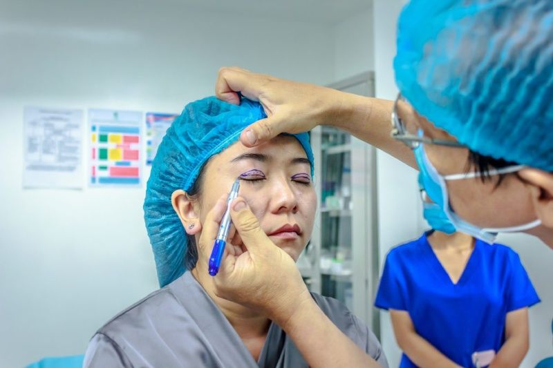 Chi phí cắt mí mắt dao động từ 12 – 25 triệu