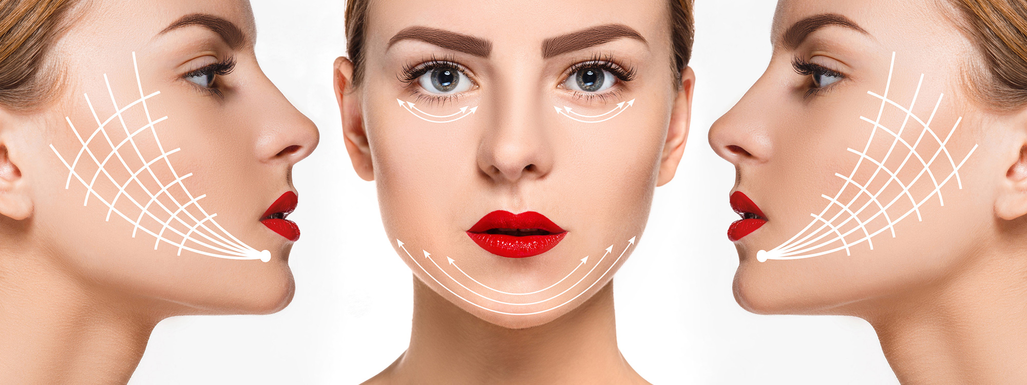 Căng chỉ collagen – Xóa đi mọi dấu hiệu lão hóa trên gương mặt