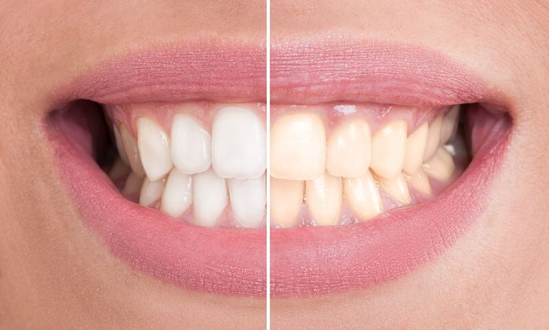 Tình trạng răng bị xỉn màu, ố vàng nên tẩy trắng tại nha khoa