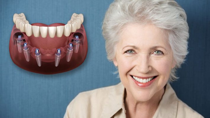 Trồng răng implant all on 6 là phương pháp như thế nào?