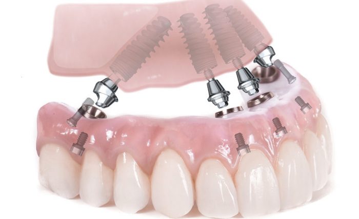 Trồng răng toàn hàm bằng kỹ thuật implant All On 4, all on 6